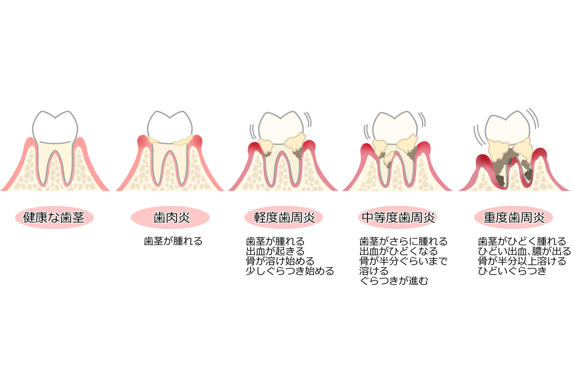 歯周病段階